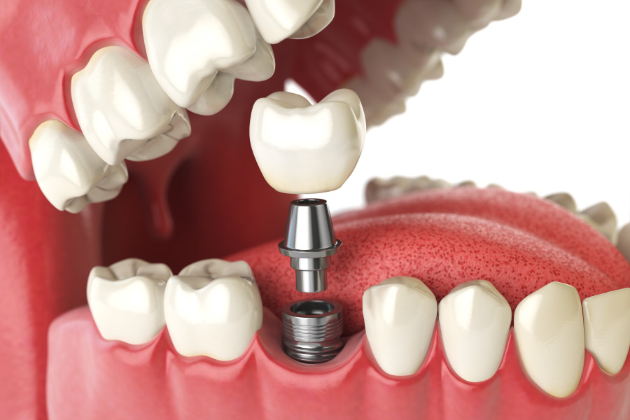 Closeup of a dental implant to replace a missing tooth