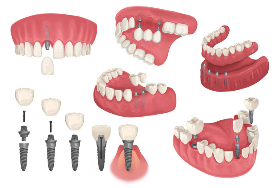 Different configurations of dental implants to replace missing teeth