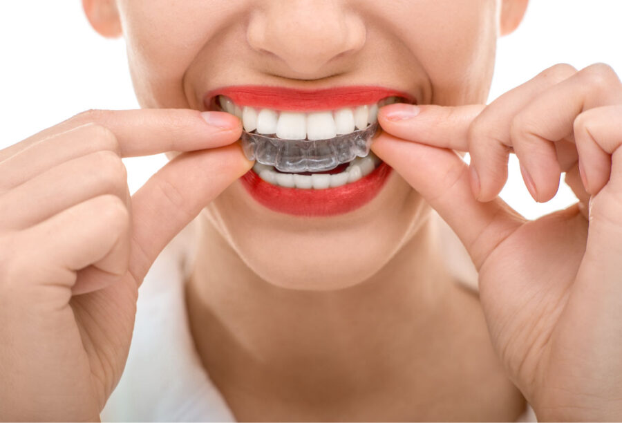 Closeup of woman with red lipstick putting on her Invisalign clear aligners
