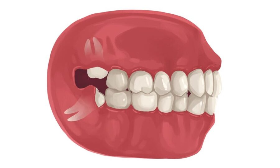 Illustration of a mouth with wisdom teeth that need to be removed