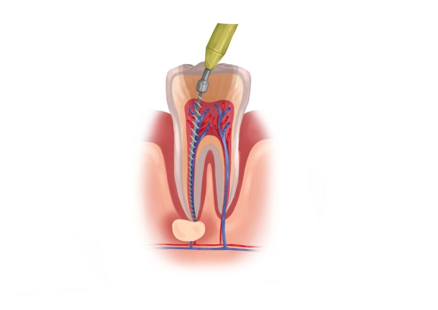 Illustration of root canal treatment
