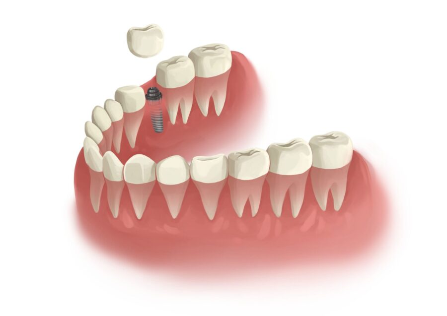 Illustration of a dental implant replacing a missing tooth in a lower jaw