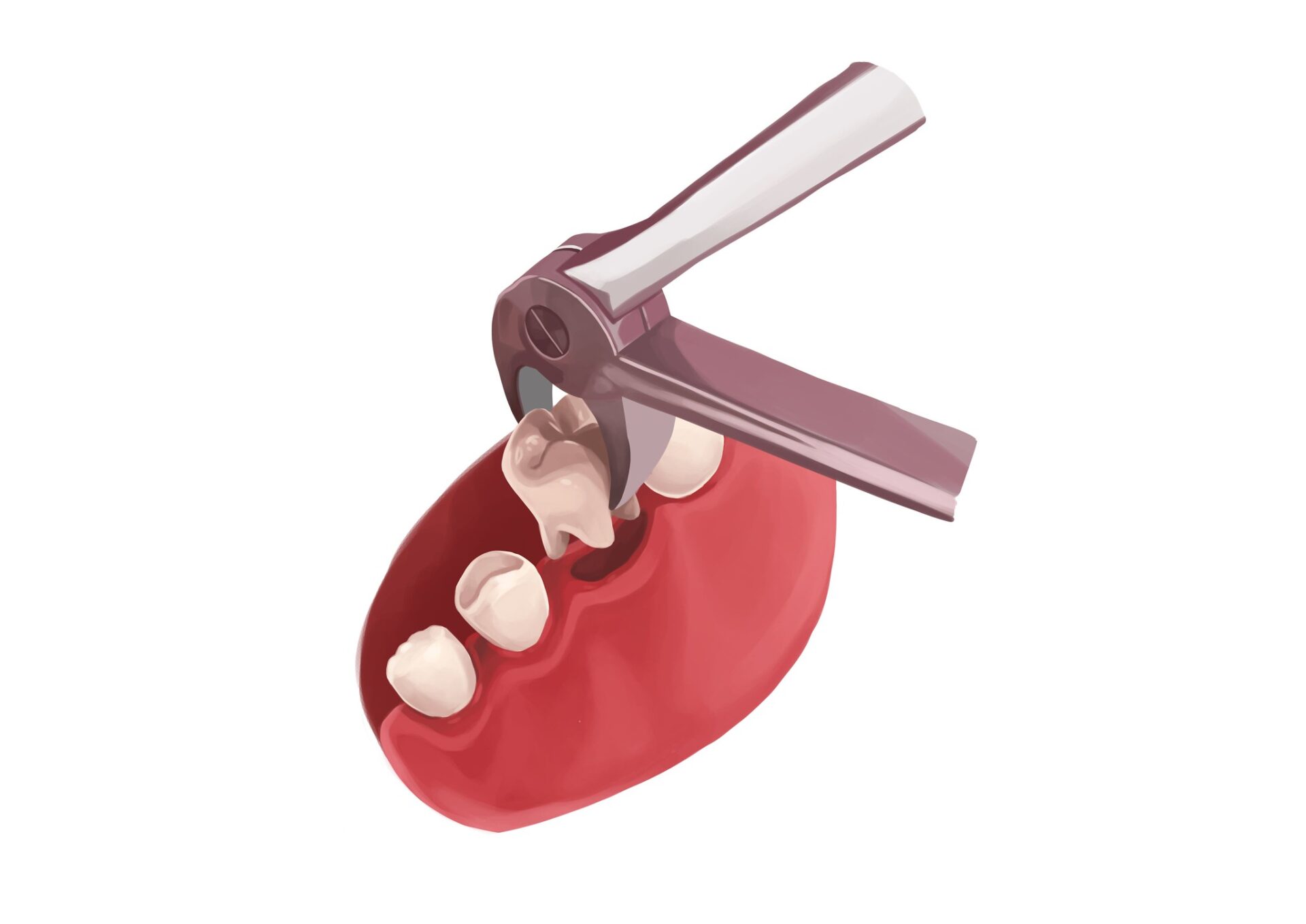 Illustration of a baby tooth being extracted with a special dental tool